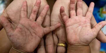 الصحة تطمئن أولياء الأمور بعدم وجود خطورة من مرض “اليد والفم والقدم”