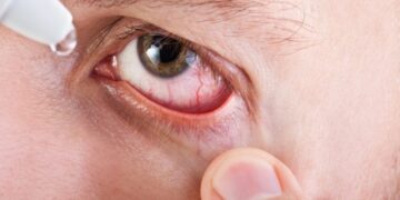 منظمة الصحة العالمية تعلن خلو مصر من «التراكوما»